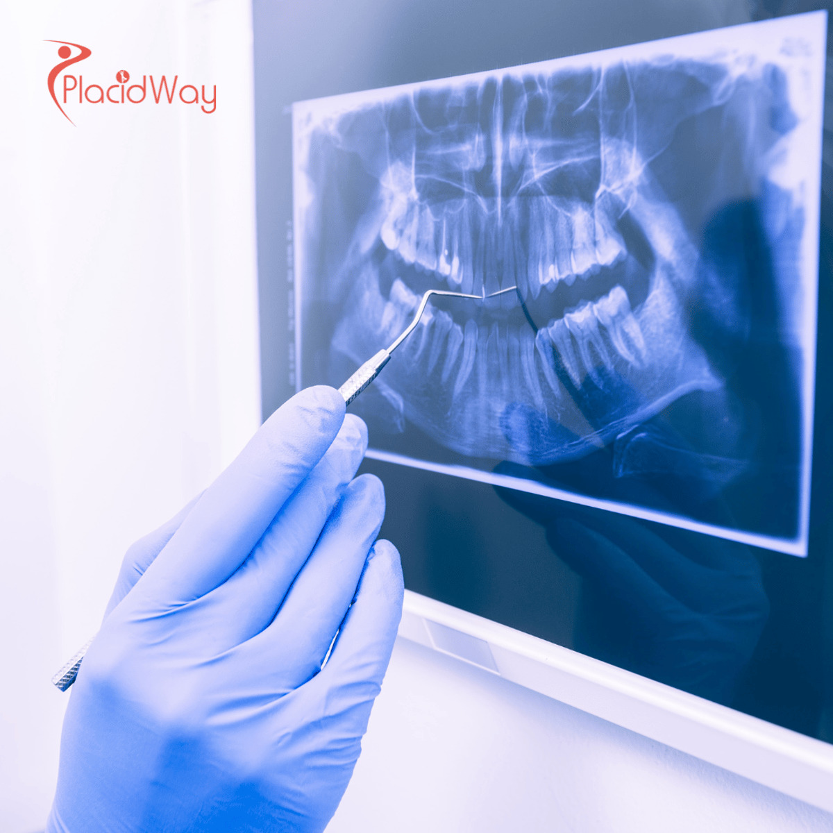 Top Dental Procedures Australians Are Getting Done in Vietnam: All-on-4 Dental Implants Leading the Way