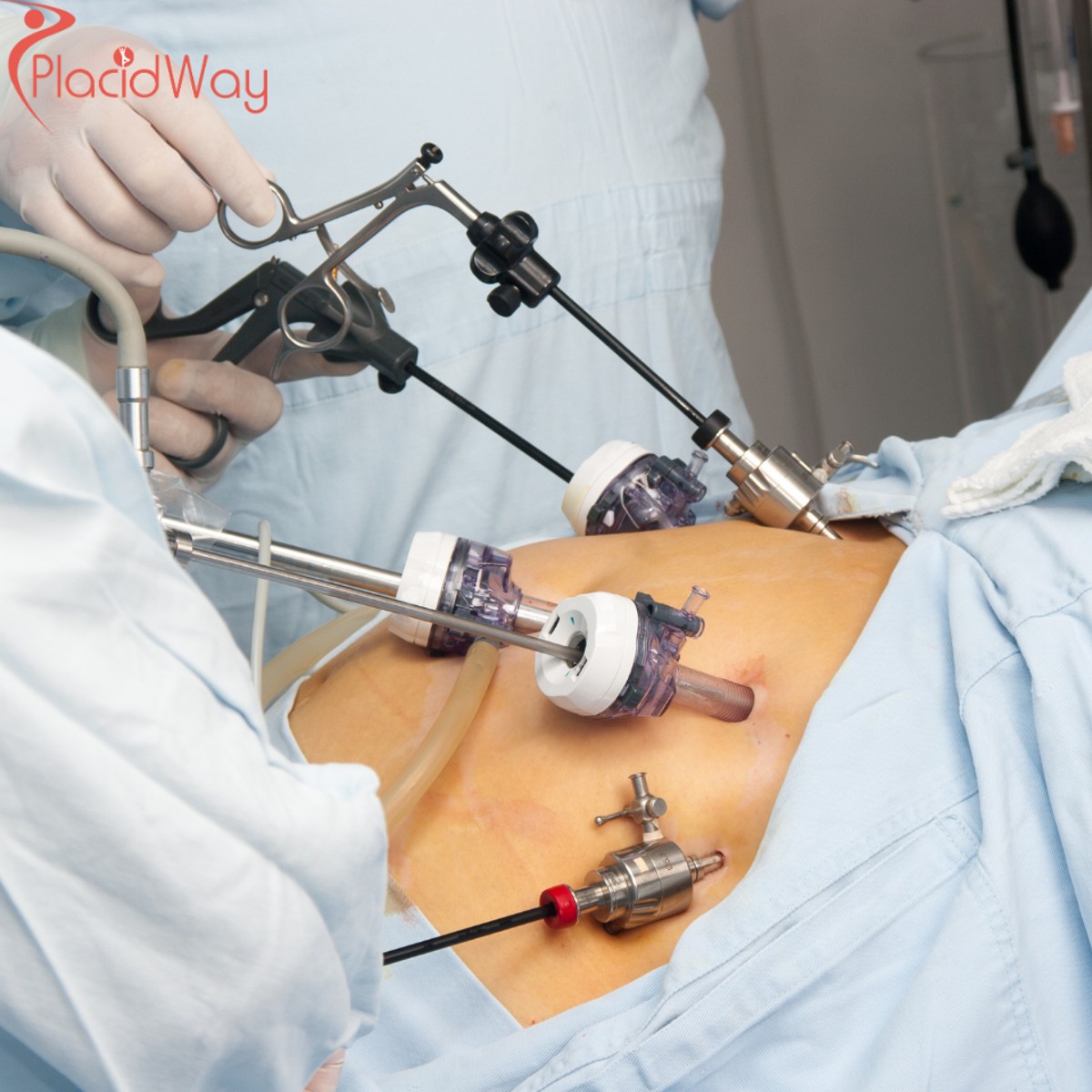 Gastric Bypass Surgery in Mexico: A Cost-Effective Weight Loss Solution for Canadians