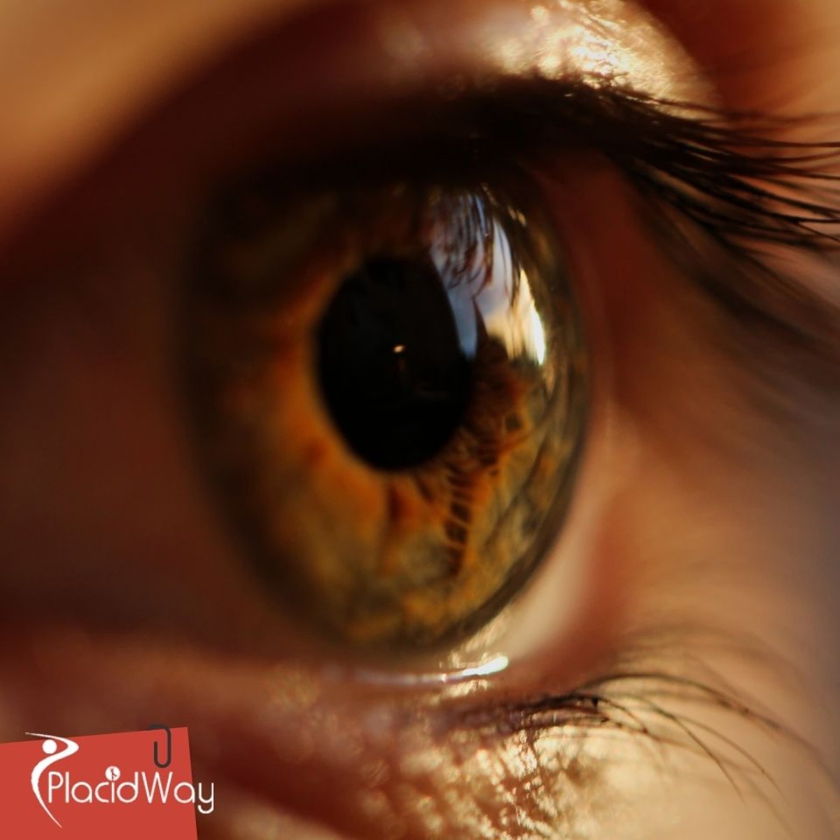 LASIK Eye Surgery in Turkey: The Popular Vision Correction Procedure for German Patients