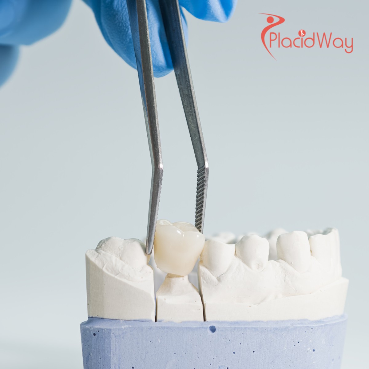 Get Your Smile Back: Affordable Dental Bridges in Thailand for New Zealanders