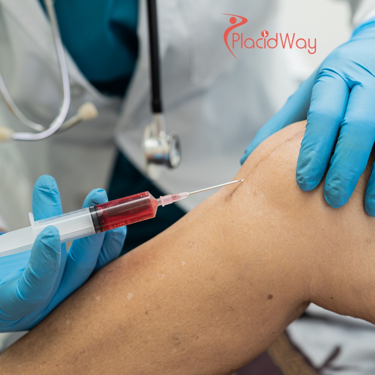 Stem Cell Treatment for Osteoarthritis: Safe, Affordable Solutions for Joint Pain