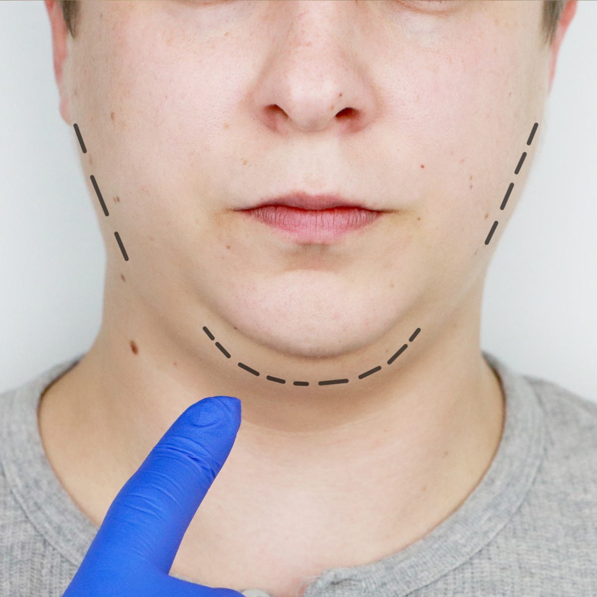 Facelift Surgery in Vietnam vs Australia – Which Is Safer and More Affordable?