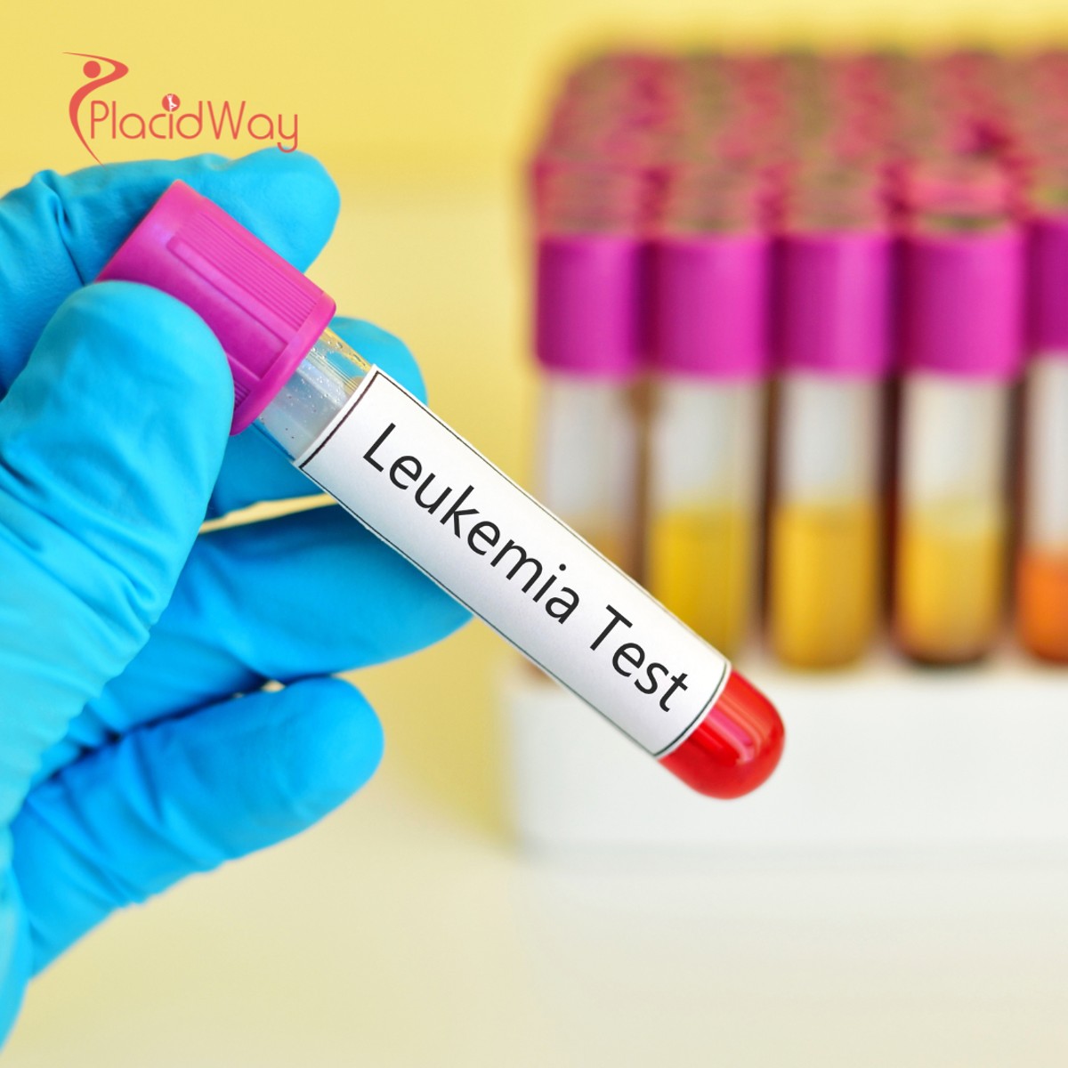 Stem Cell Transplant for Leukemia in China for Patients Requiring Specialized Hematologic Care