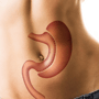 Affordable Gastric Sleeve Surgery Package in Tijuana, Mexico thumbnail