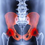 Hip Replacement in Mexico - Explore the Package thumbnail