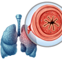 Explore Best COPD Stem Cell Treatments in Mexico thumbnail