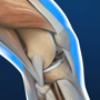 Knee Replacement Surgery Packages in India thumbnail