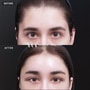 Forehead Lift Package in Seoul, South Korea by VG Plastic Surgery thumbnail