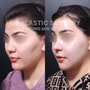 Facial Contouring Package in Seoul, South Korea by VG Plastic Surgery thumbnail