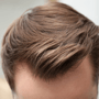 FUE Hair Transplant in Bellus Clinic - get your hair back with Bellus Clinic thumbnail