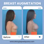 Breast Augmentation Mexico City – Affordable Package with Dr. Ary Papadopulos thumbnail