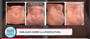 Mini Abdominoplasty Package at Dr. Ary Papadopulos - Plastic Surgery in Mexico City, Mexico City, Mexico thumbnail