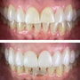 Dental Bonding & Resin Fillings Package in Nuevo Progreso, Mexico thumbnail