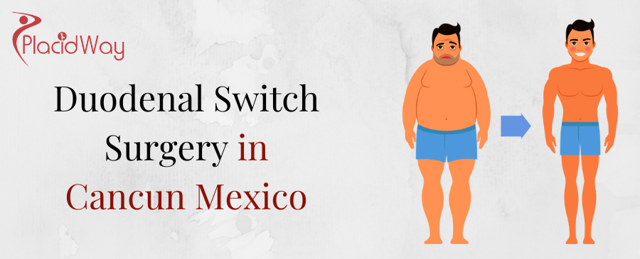 Duodenal Switch Surgery in Cancun, Mexico