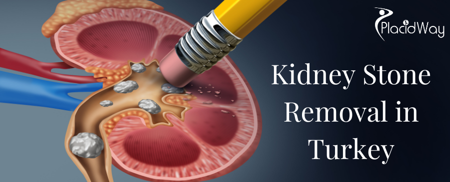 Kidney Stones Removal Surgery in Turkey