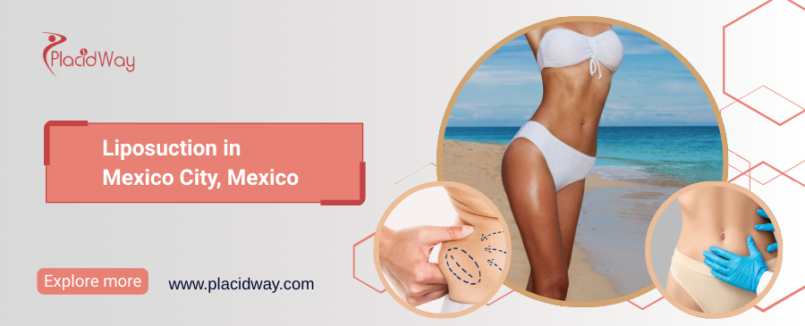 Liposuction in Mexico City, Mexico